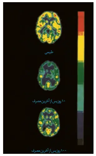  تصویر ها مصرف گلوکز را در مغز فرد سالم و فرد مصرف کننده کوکائین زیست یازدهم
